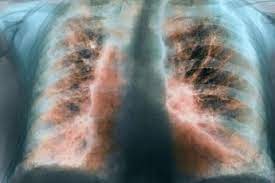توجه به درگیری دیگر ارگان های بدن  غیر از سیستم تنفسی در کودکان مبتلا به عفونت کووید -19 حائز اهمیت است.